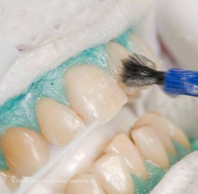 In-Office-Bleaching: Weiße Zähne in einem Termin